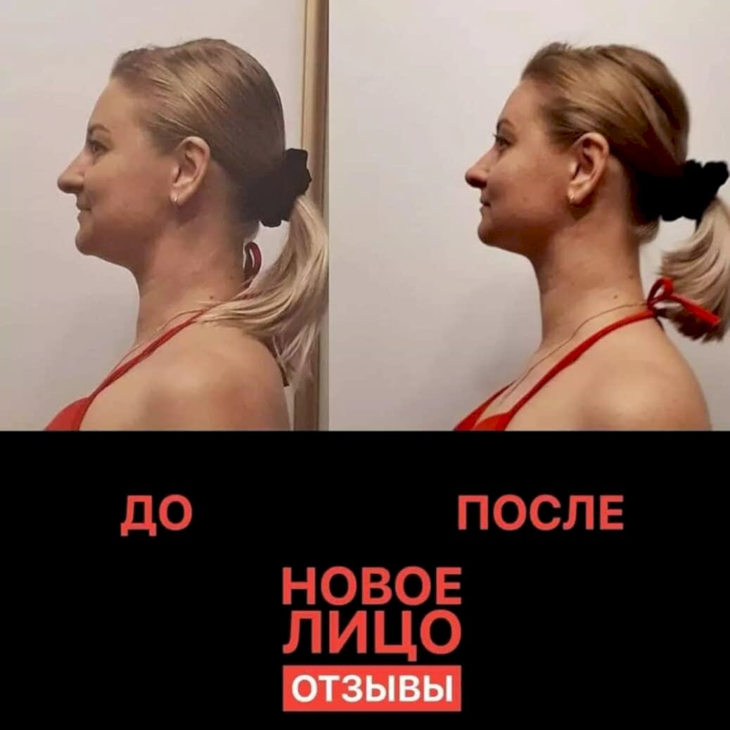 новое лицо омоложение алматы