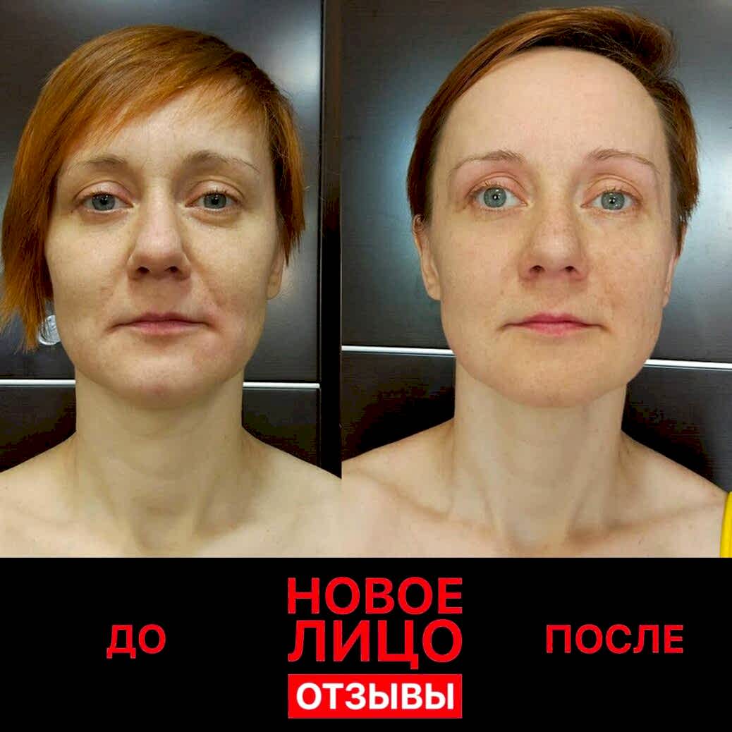 новое лицо отзывы естественное омоложение