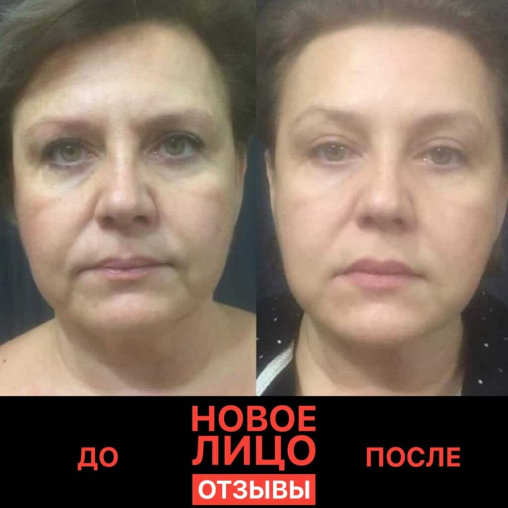 новое лицо алматы естественное омоложение отзывы
