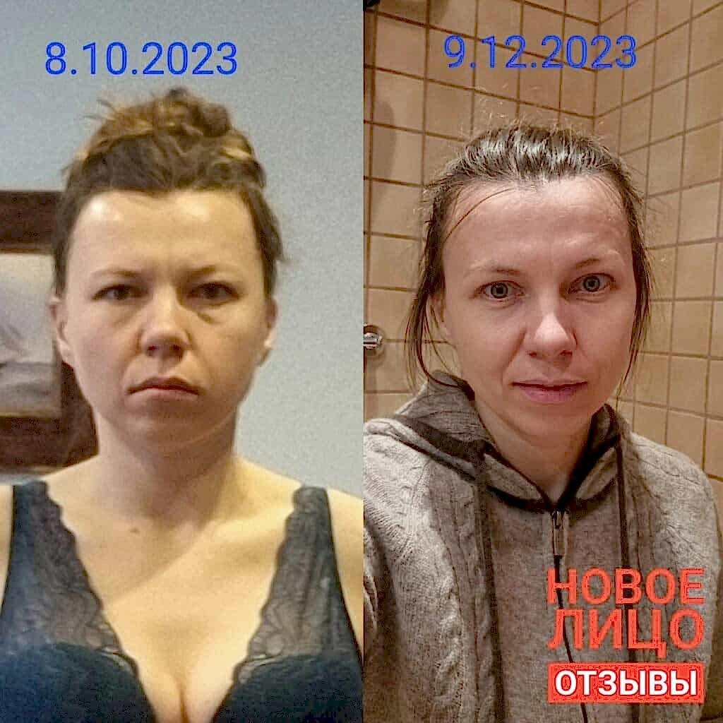 новое лицо естественное омоложение алматы алия мусина