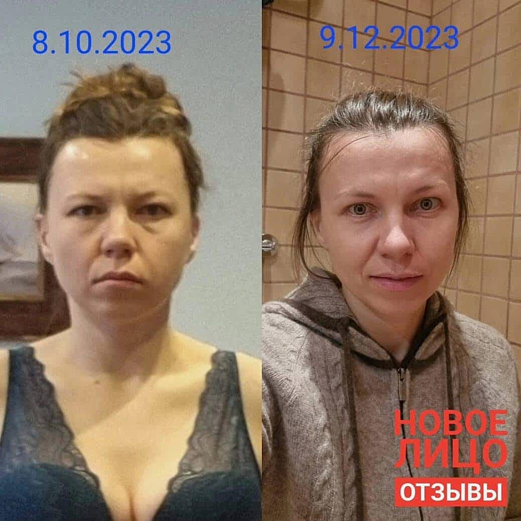 новое лицо естественное омоложение алматы алия мусина